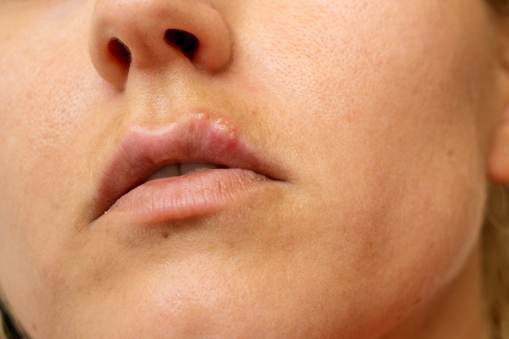 Cold Sores: Your Go-To Guide for Understanding, Treating, and Preventing Outbreaks