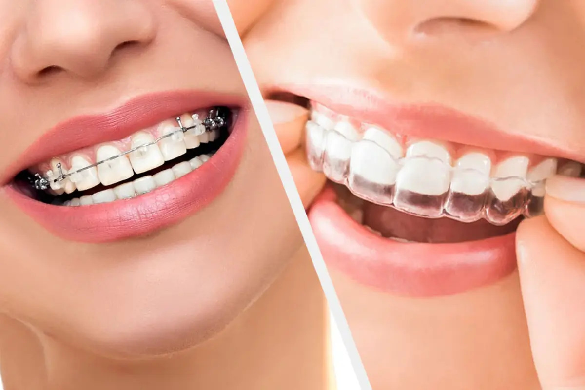Braces vs. Retainers vs. Invisalign: Choosing Your Path to a Straighter Smile