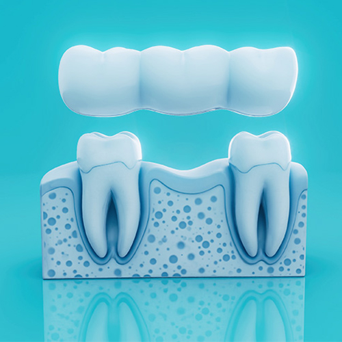 Teeth bridges in Haida Gwaii