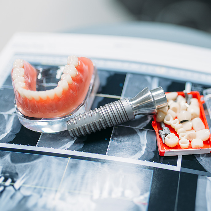 dentures repair in masset