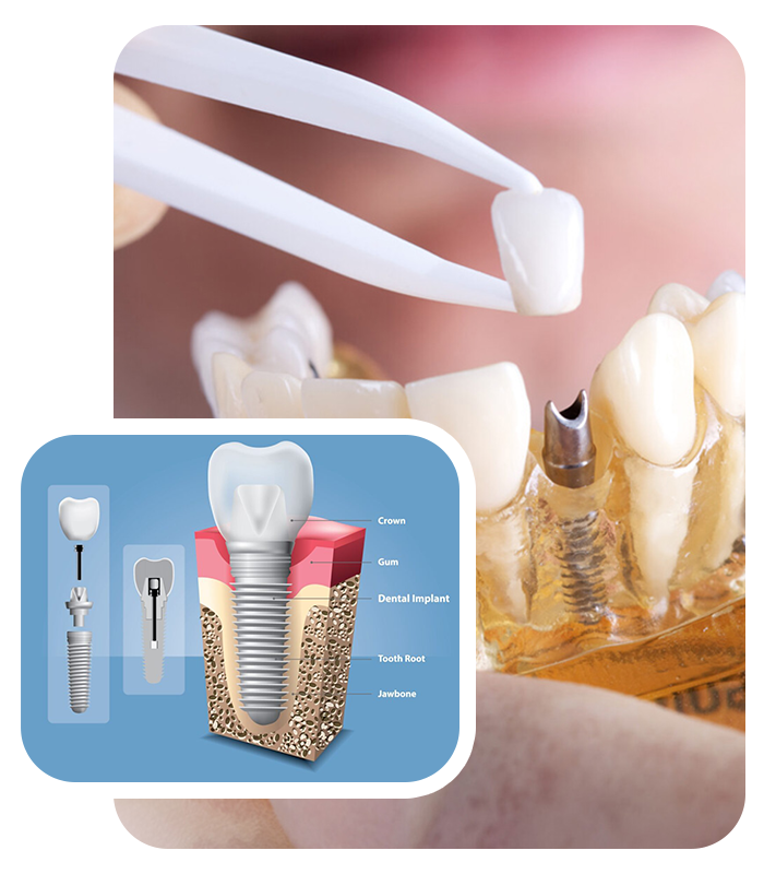 Dental implants in Masset